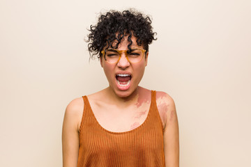 Young african american woman with skin birth mark screaming very angry and aggressive.