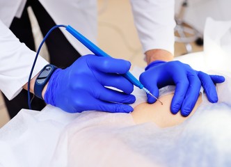 the surgeon beautician removes the patient's woman birthmark or birthmark on the hand with a radio...