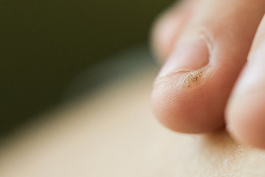 wart, papilloma on a childs finger. Macro shot, selective focus, close-up, space for text. Dermatological problems with the skin