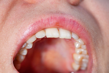 temporary filling of a tooth caries patient