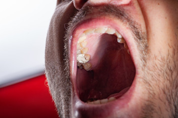 temporary filling of a tooth caries patient