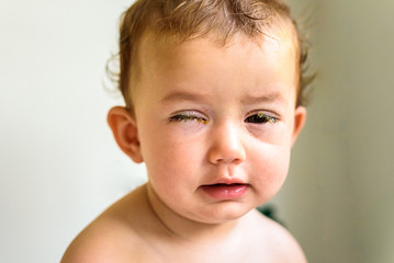 A baby with eyes full of rheum, produced by conjunctivitis, inflammation of the conjunctiva of...