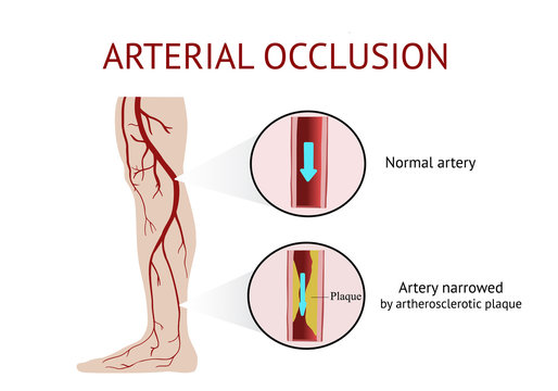 Arterial occlusion, Acute arterial occlusion, Atherosclerosis, Cramp, Vector Illustration 
