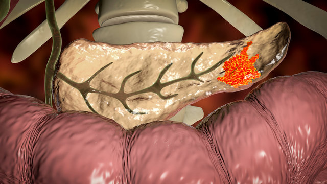 Pancreatic cancer, malignant tumor of pancreas, 3D illustration