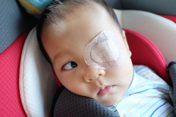Asia Infant is strabismus.