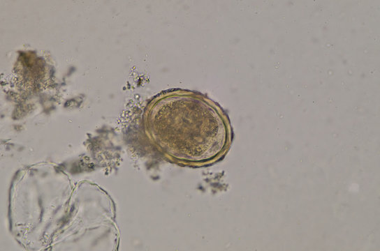 Ascaris lumbricoides egg in stool exam.