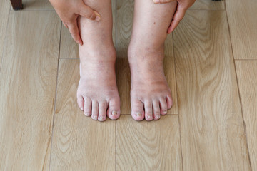 Senior woman swollen feet and leg - obrazy, fototapety, plakaty