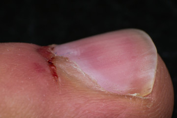 wound by cutting near the nail