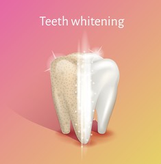 Tooth whitening in realistic 3d vector illustration.