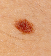 Birthmark on human skin as a background