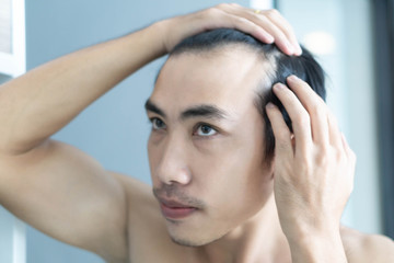 Fototapeta premium Young man serious hair loss problem for health care medical and shampoo product concept, selective focus