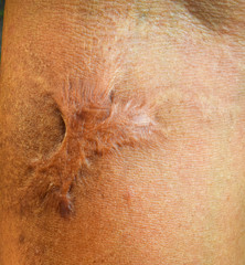Close up Keloid scar (Hypertrophic Scar) on skin.