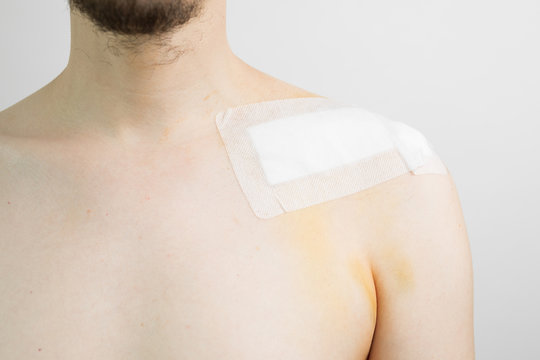 white caucasian male with a broken collarbone / clavicle / clavicula after surgery with a band aid after a bike crash