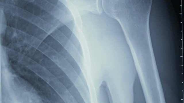 Vertical tracking shot of an x-ray of human shoulder bones, front view.
