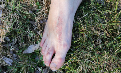 Man's leg with dermatitis. Person sitting in the nature. Barefoot on the grass. Dry scratch and...