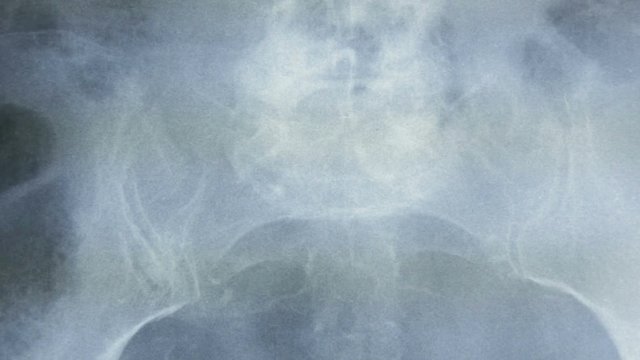 Zoon in, of a radiograph of the bones of the human pelvis, in frontal view.