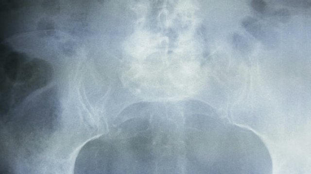 Zoon out, of a radiograph of the bones of the human pelvis, in frontal view.