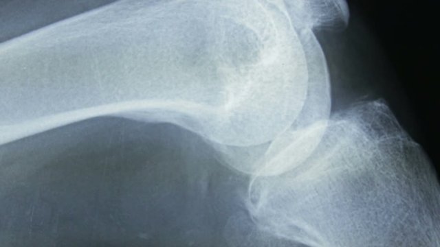 Zoon in, and progressive focusing of a radiograph of the bones of the human knees, in lateral view.