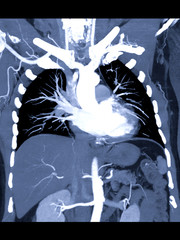 CTA thoracic aorta 3D MIP image with injection contrast media into thoracic aorta .