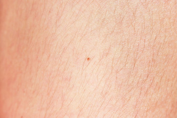 hairy legs before epilation with long black hair.