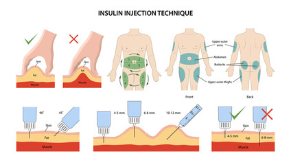 Set of images of insulin injection technique in diabetes: correct and incorrect injections depending on length of needle, insulin injection sites and sequence of injection sites. Vector illustration. - obrazy, fototapety, plakaty