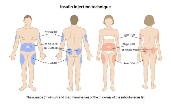 Diabetes. Average, minimum and maximum values of the thickness of the subcutaneous fat on the insulin injection sites are shown on male and female bodies. Vector illustration in flat style.