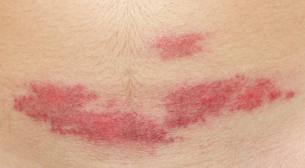 midge mosquito bite. reaction to the bite of midges. allergy. danger of insect bites in the summer. red spot at the bite site after a day