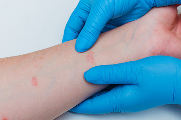 Diagnosis of skin diseases - allergies, psoriasis, eczema, dermatitis. A dermatologist with gloves...