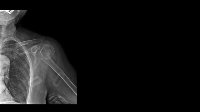 Film x-ray shoulder radiograph show shoulder dislocation and bone broken (neck of humerus fracture) from sport injury. The patient also has rotator cuff tendon injury. Medical imaging concept.