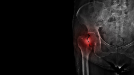 Film X ray hip radiograph show broken hip bone ( neck of femur fracture ). The elderly patient has...