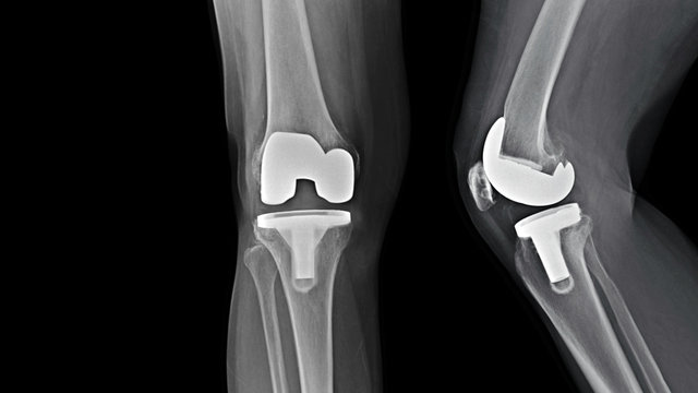 Film X-ray knee radiograph showing degenerative osteoarthritis (OA knee disorder) treated by total knee replacement surgery ( TKR ) or joint prosthesis and free copy space. Medical technology concept.