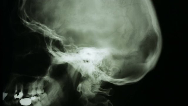 Zoon out, of a radiograph of the bones of the human skull, in lateral view.