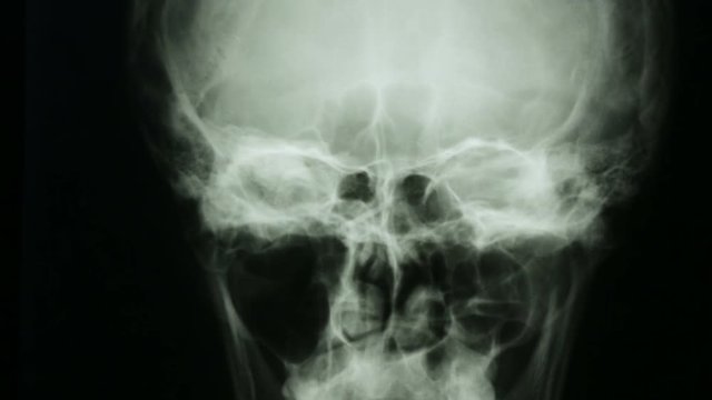 Zoon in, of a radiograph of the bones of the human skull, in front view.