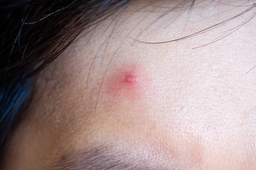 Fototapeta premium Inflammatory acne with red spot on face closeup