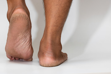cracked heel dry skin foot skin on white background