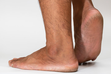 cracked heel dry skin foot skin on white background