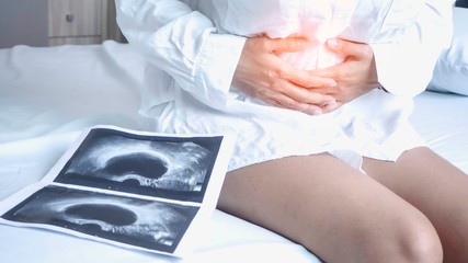 Obraz premium Uterus, ovaries, Ovarian cysts and abnormalities in cells, Close to each other, woman sitting closed to her stomach because of abdominal pain and a X-ray film.
