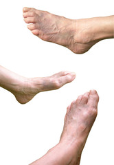 Bruised feet of an elderly woman. Hematoma, large, blue foot. Trauma of the lower limb, foot injury 