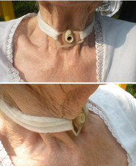 tracheostomy of an old woman after thyroid surgery. Tracheostomy tube