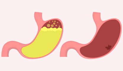 Cartoon illustration Gastric diseases, medical.