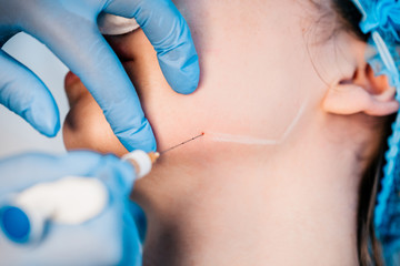 Contour plastics - injection rejuvenation by introducing into the middle layers of the skin filler preparations (fillers) based on hyaluronic acid