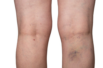 Bursted capillaries on a woman leg