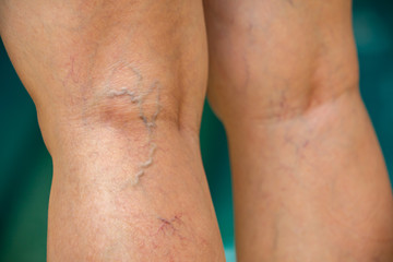Varicose veins on the back of knees and legs in woman, Blue swimming pool background, Close up and...