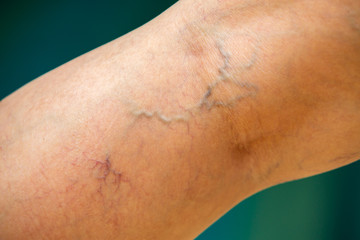 Varicose veins on the back of knee and leg in woman, Blue swimming pool background, Close up and...