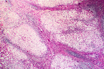 Histopathology of portal liver cirrhosis, light micrograph, photo under microscope