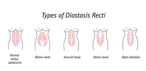 Different types of Diastasis Recti. Woman anatomy. Vector illustration of diastasis after pregnancy. Abdominoplasty.