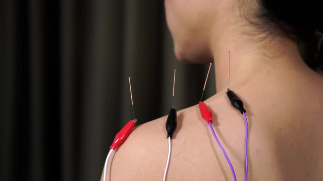 young woman undergoing acupuncture treatment with electrical stimulator on shoulder