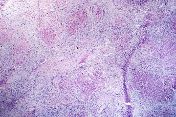Histopathology of postnecrotic liver cirrhosis, light micrograph, photo under microscope