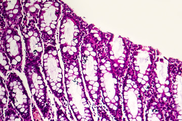 Bacillary dysentery, light micrograph, photo under microscope showing presence of bacteria and accumulation of inflammatory cells