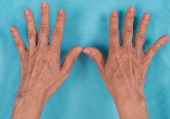 Inicial change in rheumatoid arthritis.  Ulnar deviation